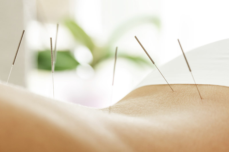 Akupunktur Behandlung 